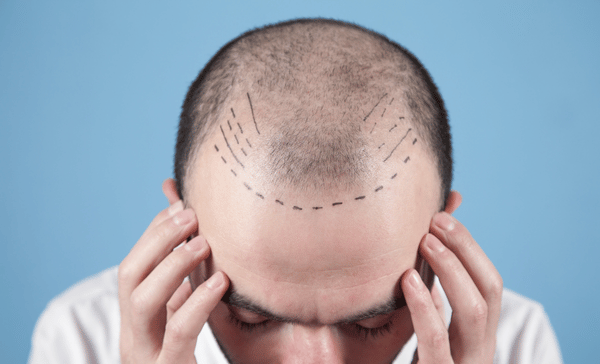 hair transplant